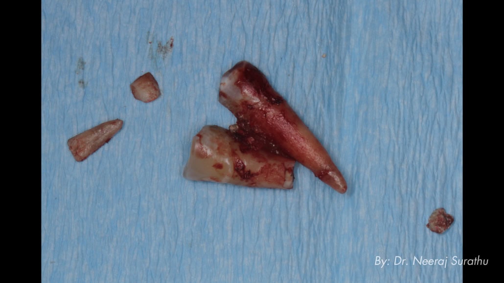 Image of an extracted #5 (First bicuspid/premolar)
