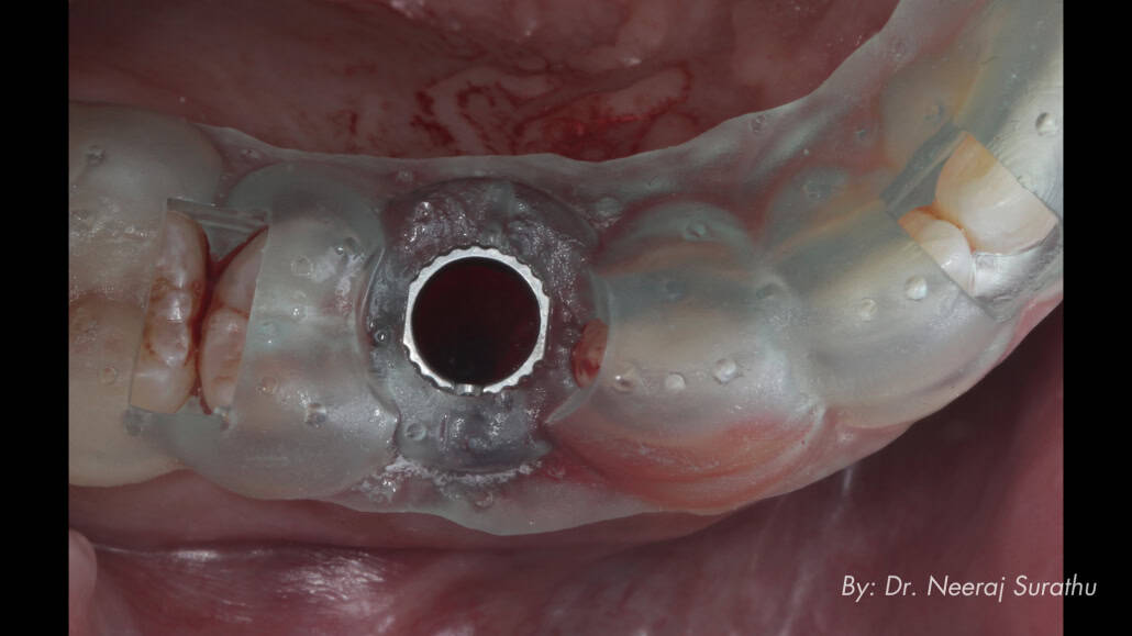 3D printed surgical guide in place to guide implant placement in #5 (First bicuspid/premolar)