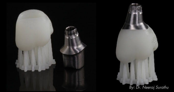3D printed dental crown perfectly fitting on an abutment