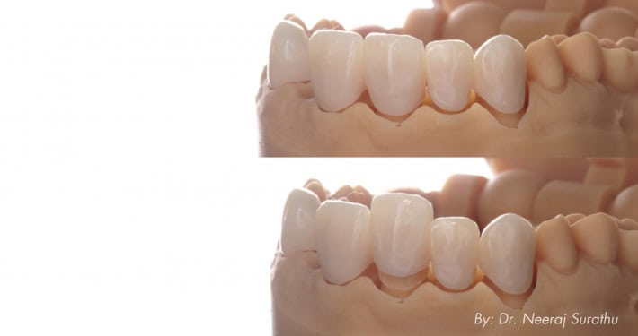 Image of perfectly fitting 3D printed dental crowns sitting on a dental model